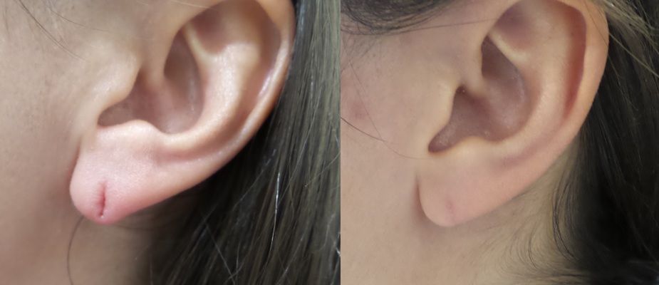 torn earlobe repair surgery