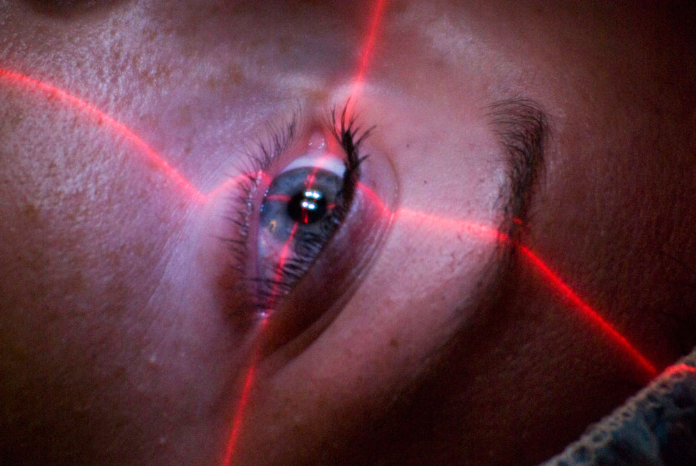 laser-eye-surgery-lima