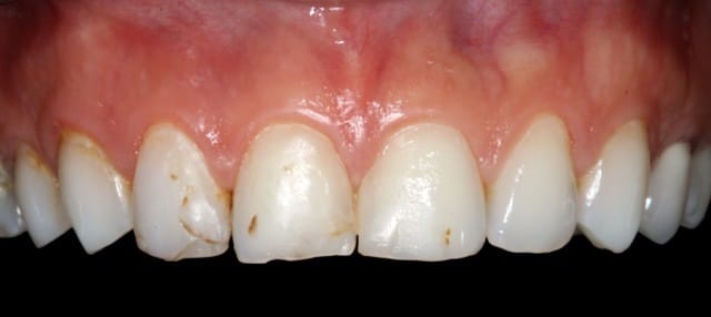 smile design veneers