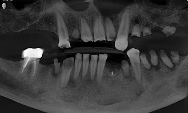 full mouth reconstruction