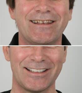 3D CAD CAM dental crowns lima peru