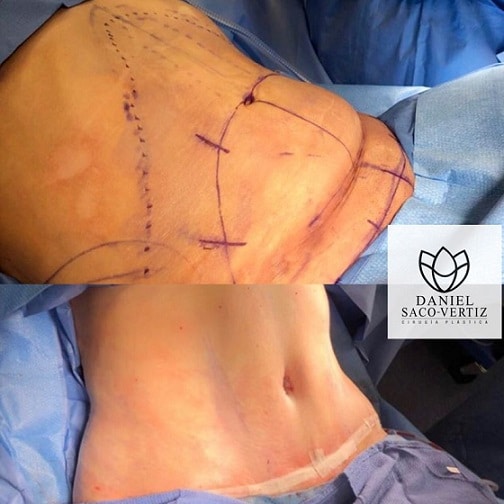 Tummy Tuck (Abdominoplasty) in Lima - Cosmetic Surgery in Peru