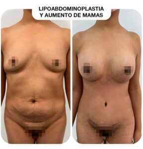 breast augmentation abdominoplasty combo
