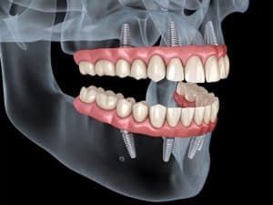 All-on-4 or All-on-6 dental implants