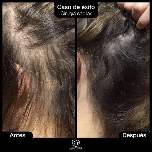 Alopecia Feminina
