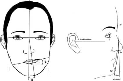 Asimetría facial – condilectomía