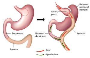 Bariatric Surgery in Lima