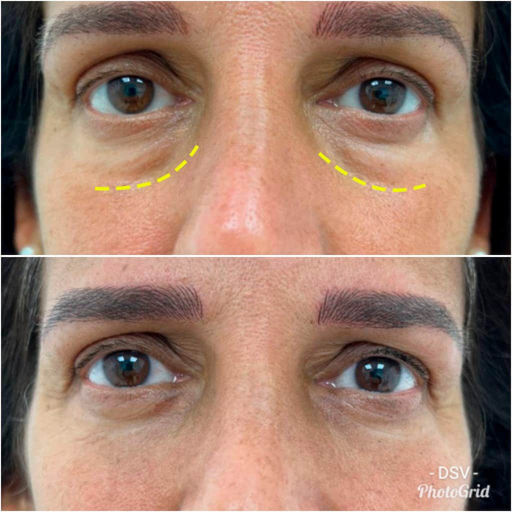 Blefaroplastia cirugía de párpados