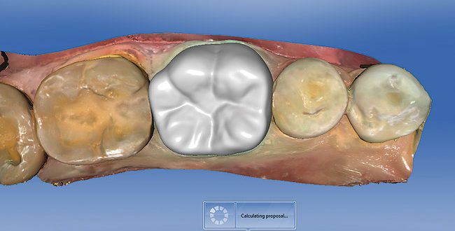 3D CAD CAM Crowns