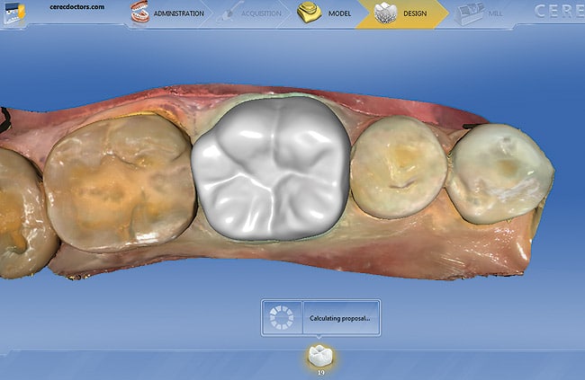 3D CAD CAM Crowns