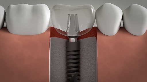 dental implants lima peru