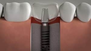 Dental implant lima