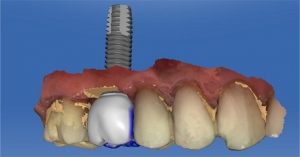 dental implant technology