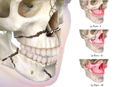 Fractura Le Fort