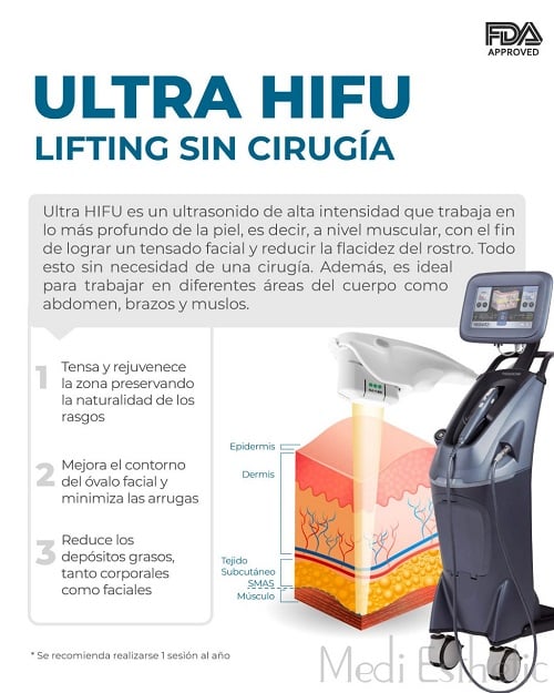 HIFU Lifting sin cirugía