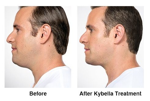 Kybella