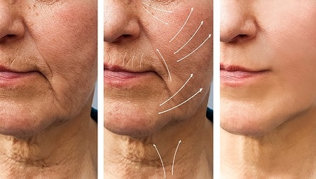 fat transfer facelift