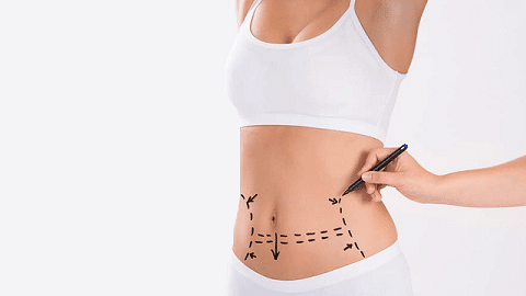 Mini abdominoplastia