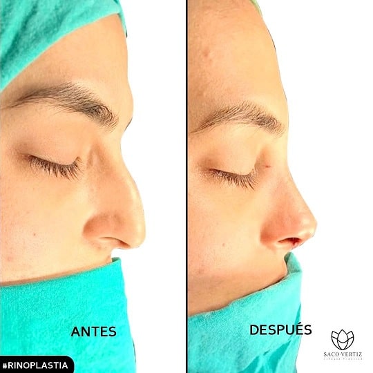 closed rhinoplasty