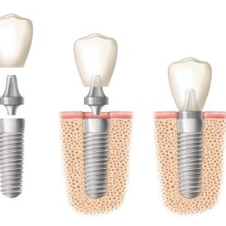 dental implants lima
