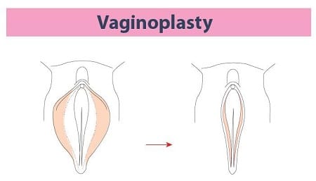 Vaginoplasty