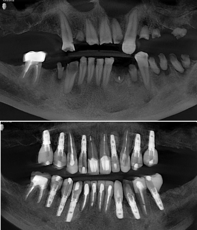 dental implants case study
