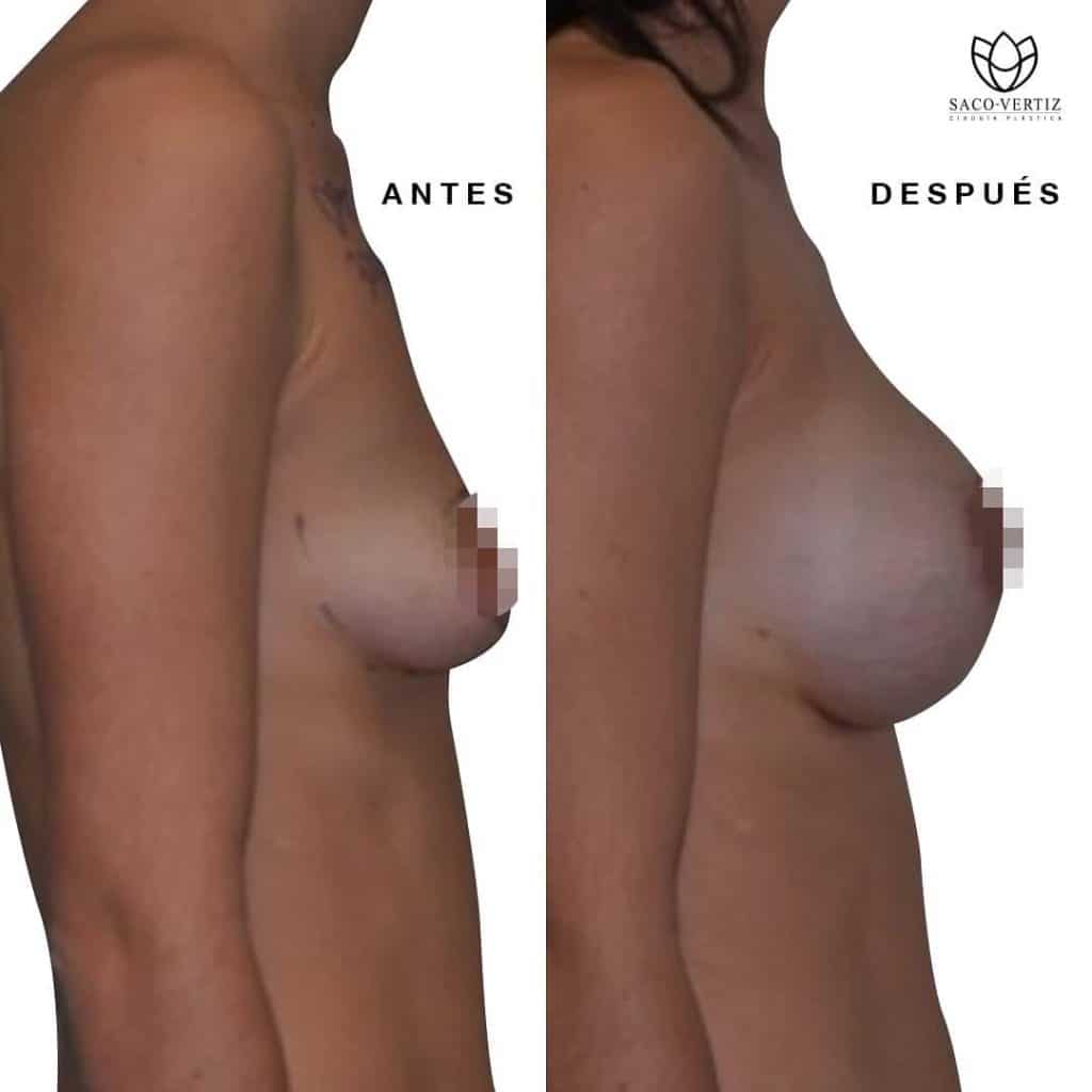 breast implants in peru