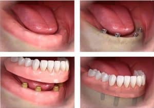 all on 4 dental-implantes-lima