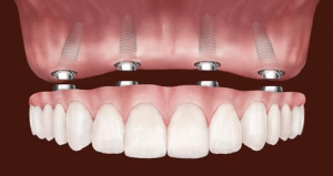 all-on-4-dental-implants-lima-peru