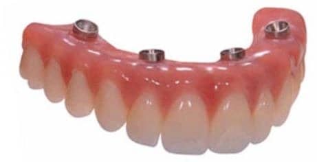 all-on-4-dental-implants-lima-peru