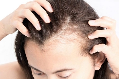 Alopecia in women