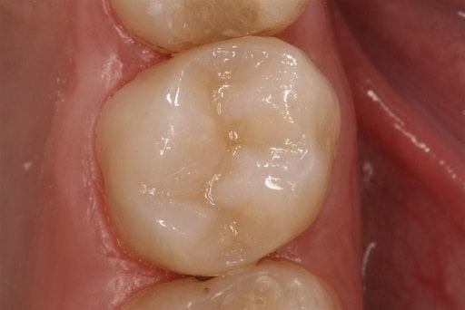 amalgam removal inlay