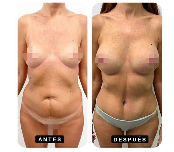 breast augmentation abdominoplasty