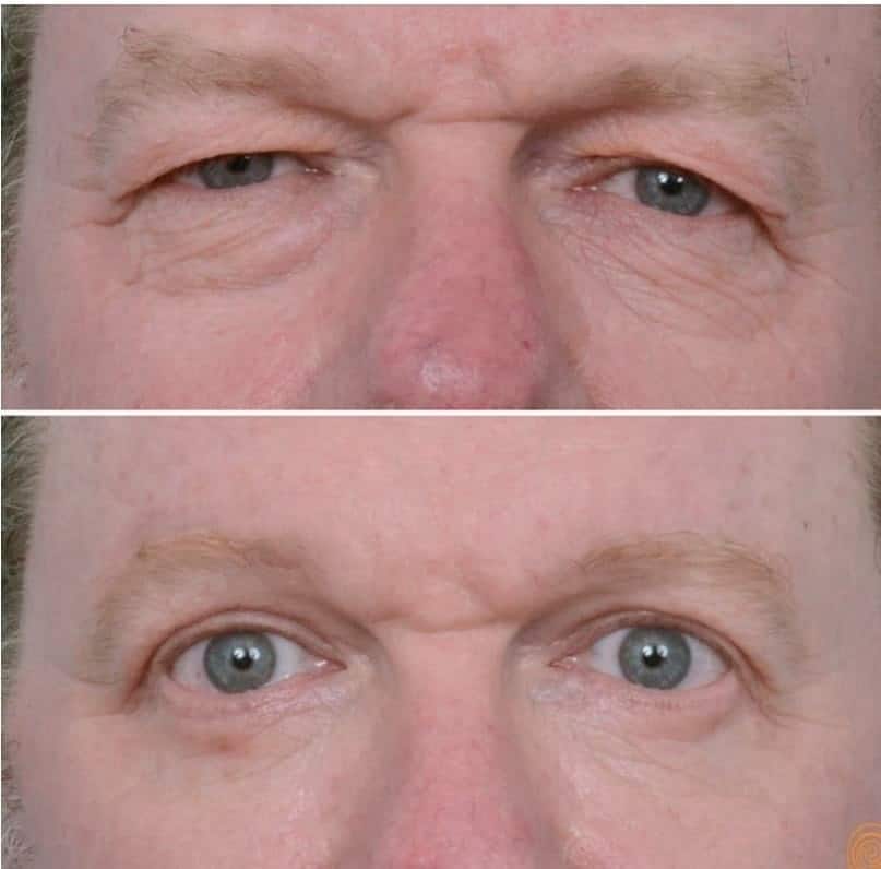 Facial Surgery Blepharoplasty