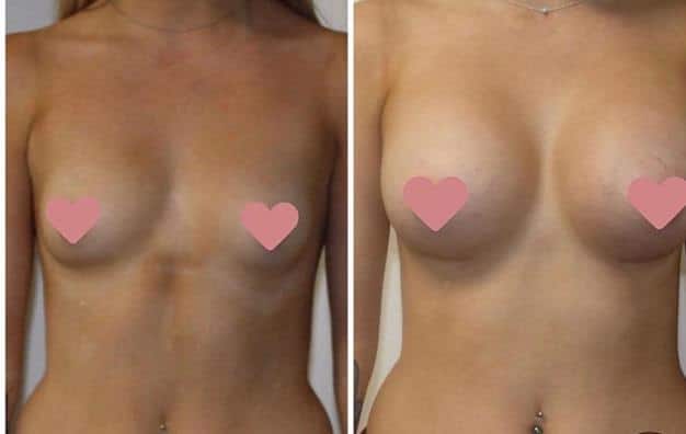 breast implants in peru with Motiva Round