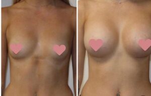 breast augmentation mammoplasty