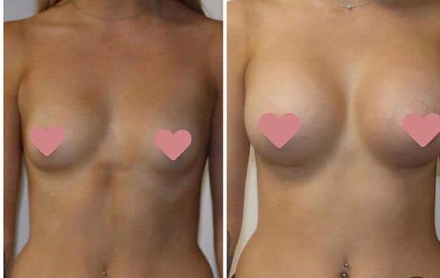 breast augmentation