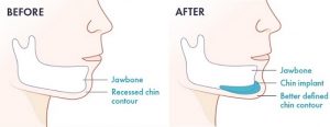 chin implants lima