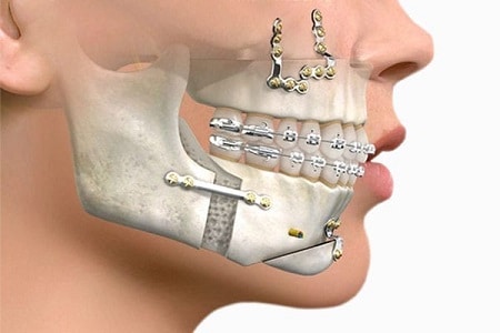 Orthognathic maxillofacial surgery