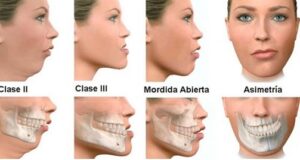 Orthognathic maxillofacial surgery