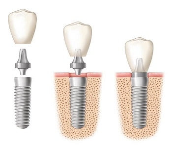 multiple dental implants