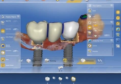 implantes dentales y la tecnología