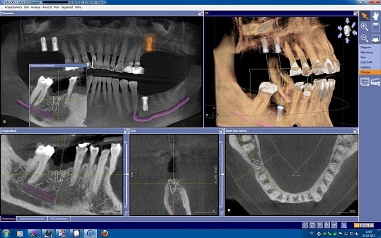 planificacion de implantes dentales