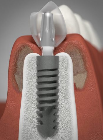 bone graft dental implant