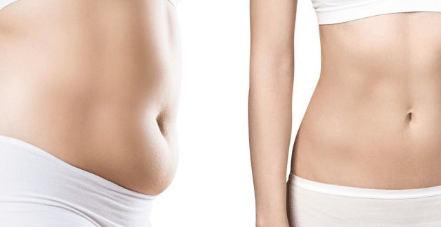 Dermolipectomy