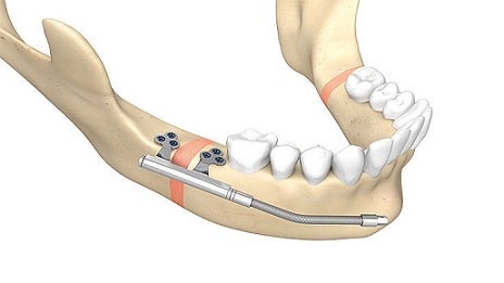 distracción mandibular