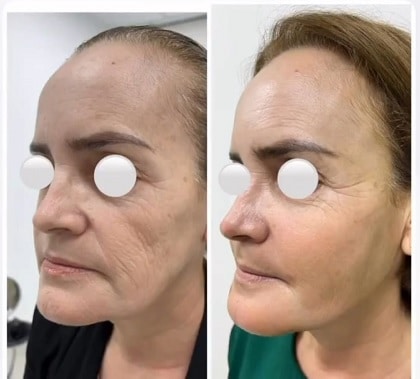 face fat grafting