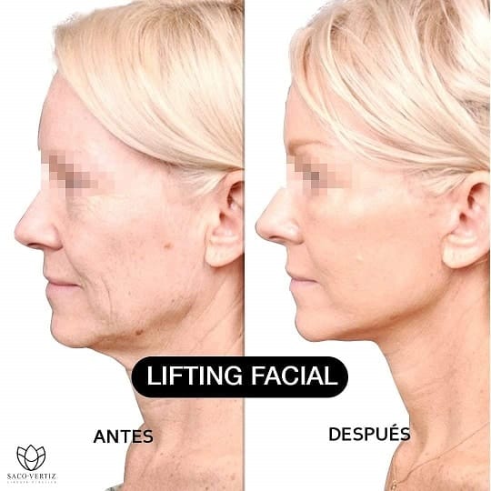 Lifting Facial y de Cuello Combo Cirugía Plástica y Estética en Peru