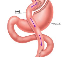 gastric bypass lima
