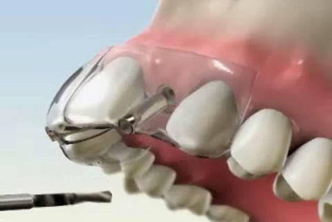 quía quirúrica 3d implantes dentales